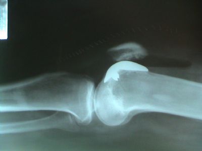 Knee Prostheses:  Patellofemoral:  Centerpulse PFJ (Implant 167)